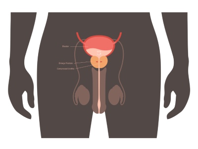 dysuria megnagyobbodott prosztata